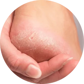 foot with calluses