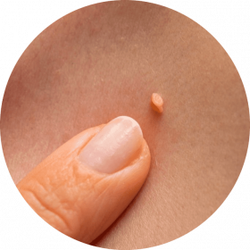 benign papilloma warts on skin