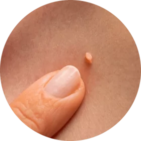 benign papilloma warts on skin